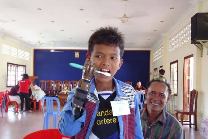 A young boy with a prosthetic hand