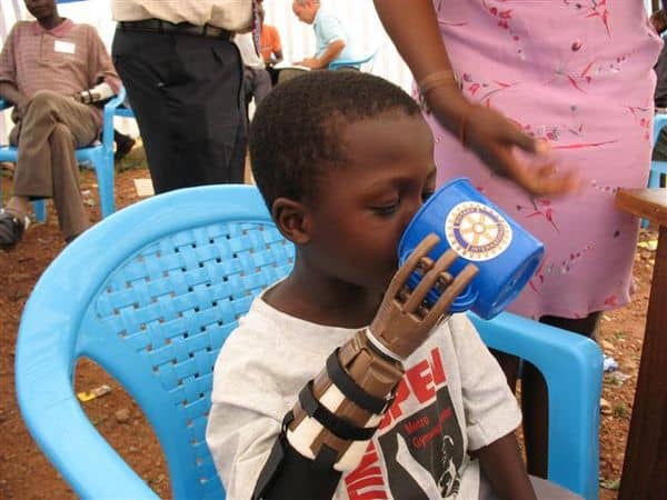 A young boy with a prosthetic hand drinking from a cup